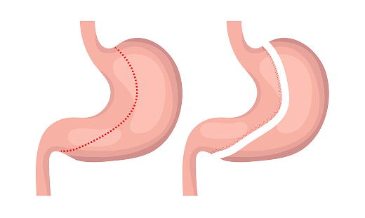 Sleeve Gastrectomy Dubai